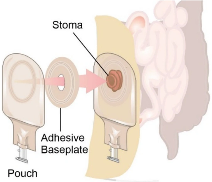 types-of-colostomy-pouches-guide
