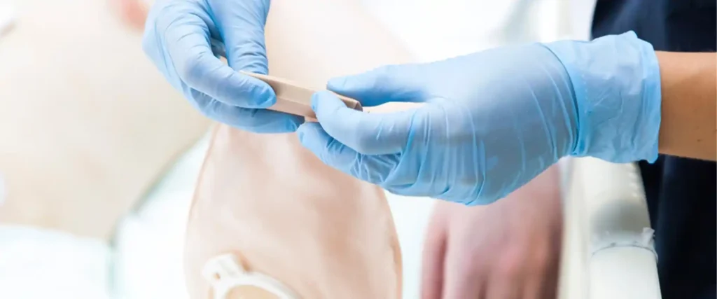 how to change a urostomy bag