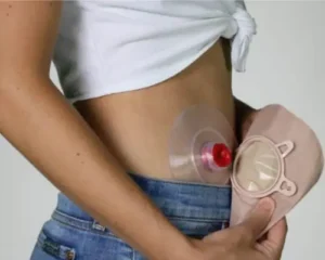 where to buy colostomy bags