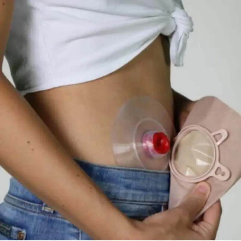 What Is an Colostomy?