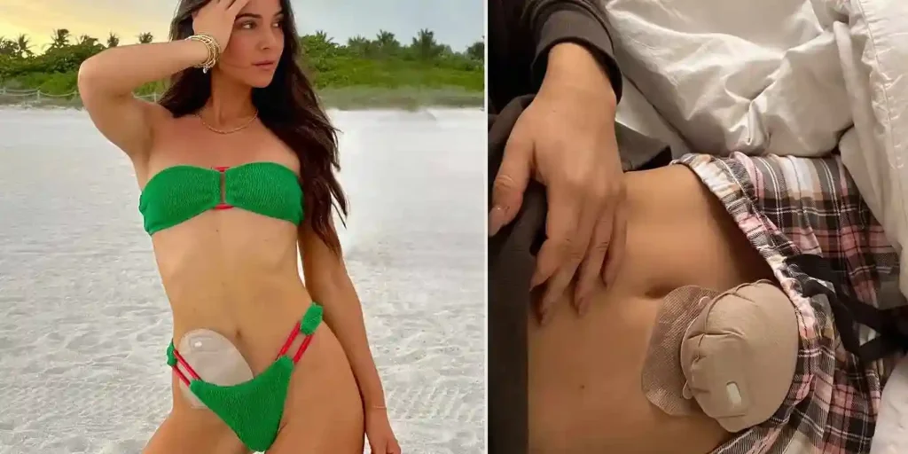 Can I Go Swimming With A Colostomy Bag？