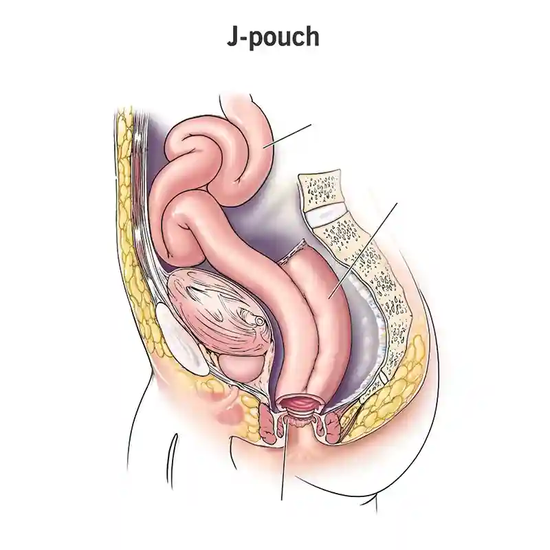 What is a J-pouch?