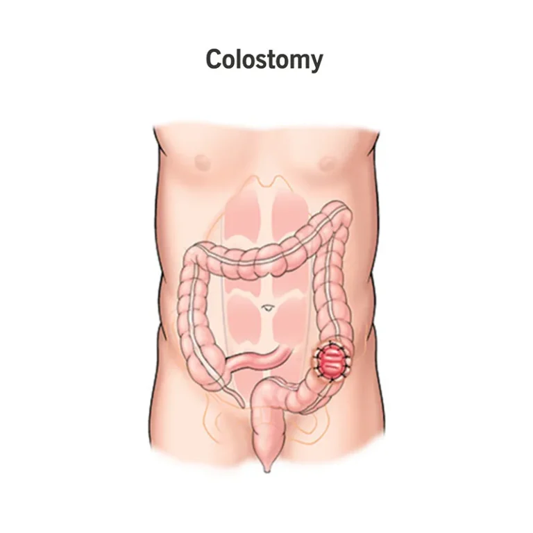 10 causes for colostomy bag