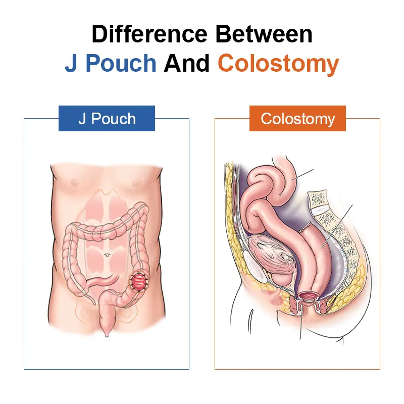 Difference Between J Pouch And Colostomy
