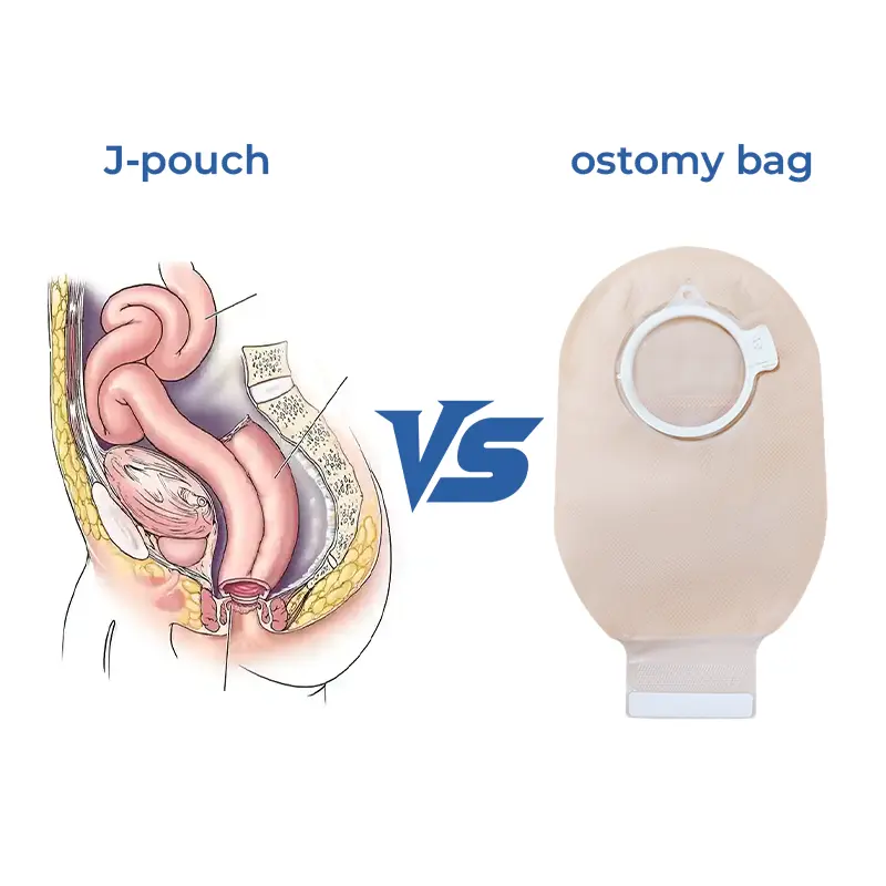 J Pouch Vs Ostomy Bag: What’S The Difference?