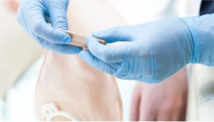 which colostomy bag is the best