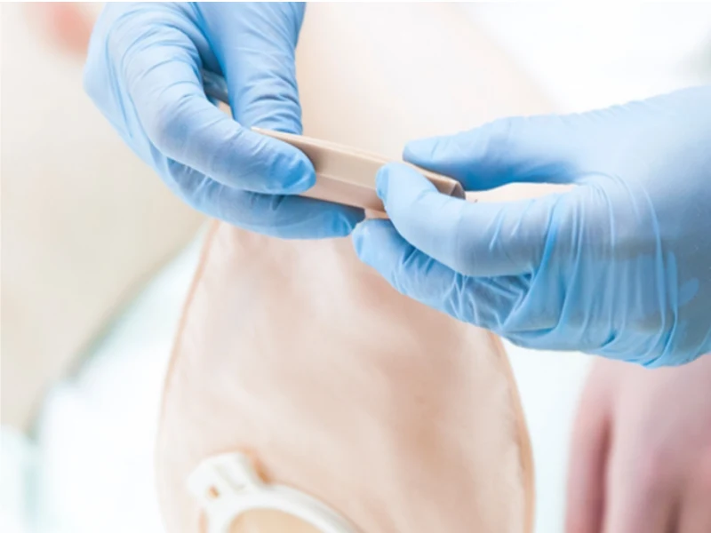 Ostomy Bag Supplier