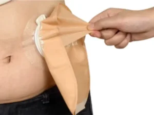 advantages of colostomy bag