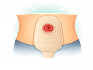 Post-surgery recovery period