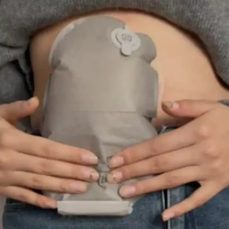 Stoma Bag Ballooning at Night: Causes, Solutions