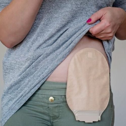 how to prevent ostomy bag leakage